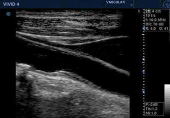 Sono Carotis Sono Carotis